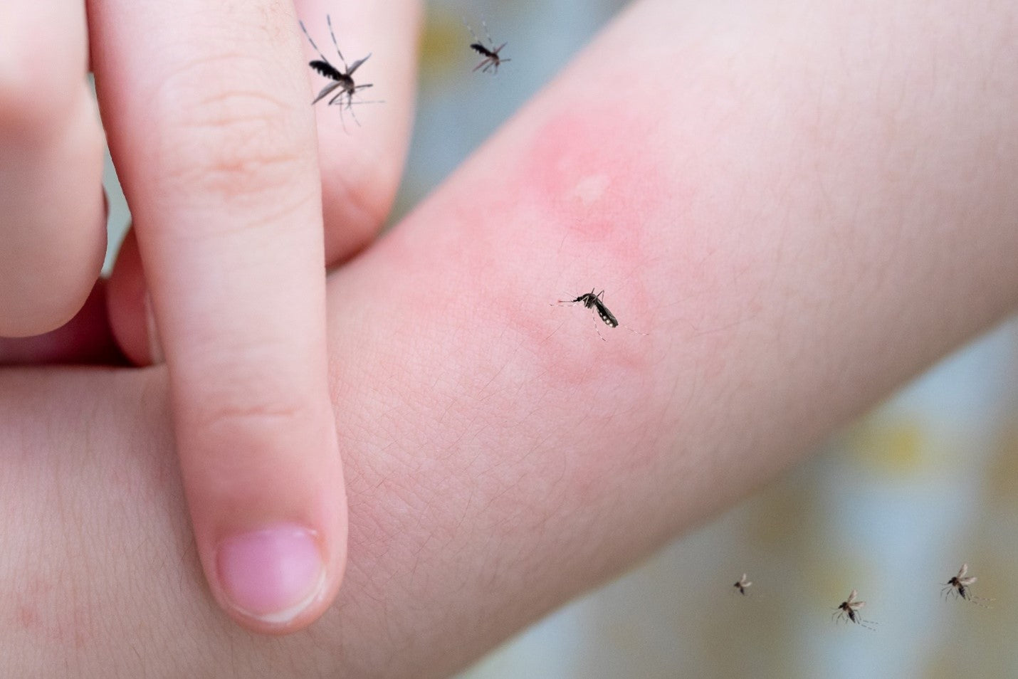 How To Treat Bruises With Mosquito Bites MosquitoNix bed-bugs-rash-treatment