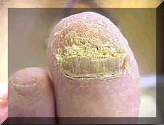 advanced nail fungus
