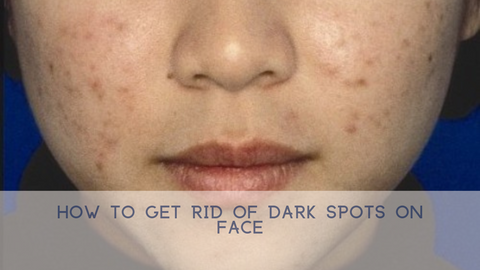 How to Get Rid of Dark Spots on Face?