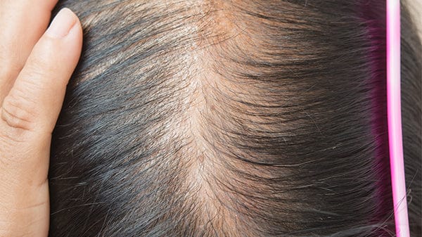 Hair Loss After Pregnancy