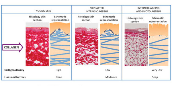 Premature skin aging