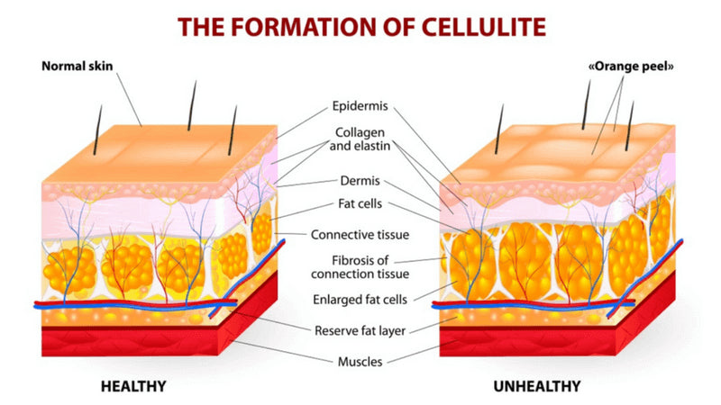 how to remove cellulite skin