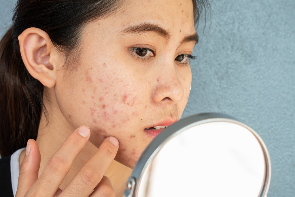 does collagen help with acne