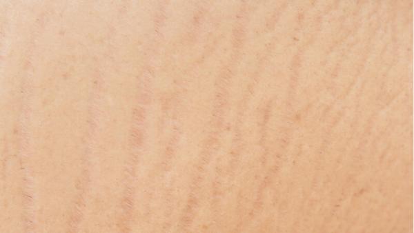 how can i get rid of stretch mark