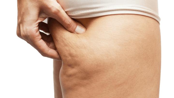 Reduce Cellulite Without Reducing How Much You Eat