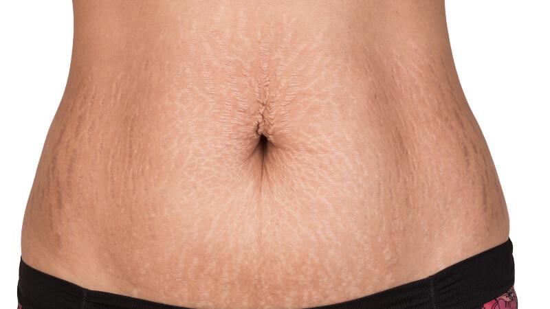 what helps with stretch marks stomach