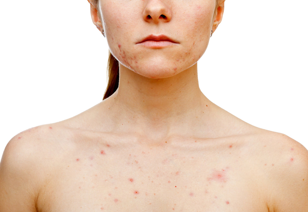 what is fungal acne