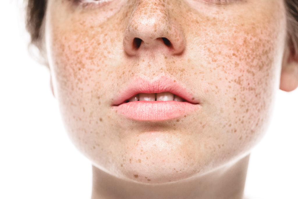 what is hyperpigmentation