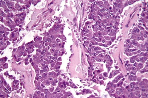 purple pancreatic cancer histology slide