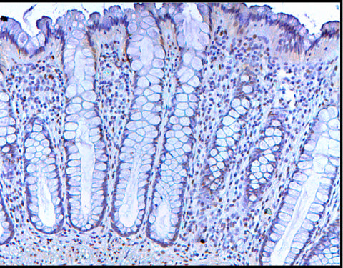 colon cancer cell image