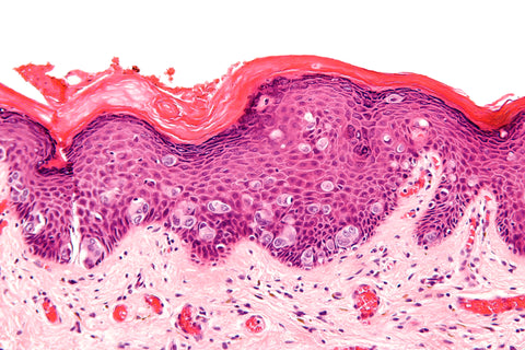 Breast cancer cell histology slide