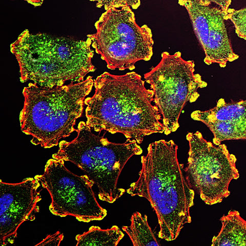 melanoma histology slide