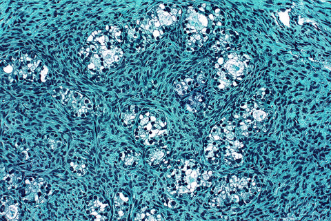 ovarian cancer cell image