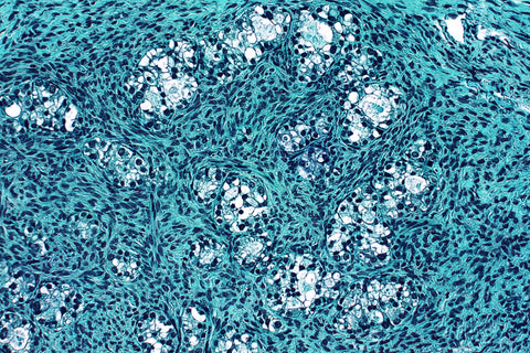 ovarian cancer cell histology slide