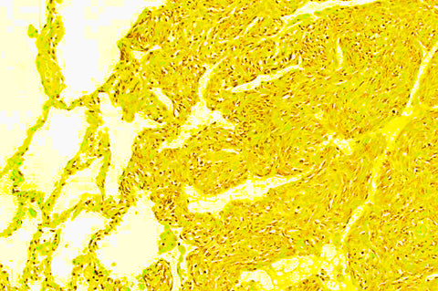 sarcoma cell image slide