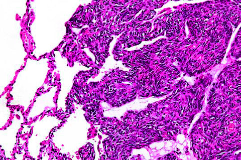 synovial sarcoma histology slide