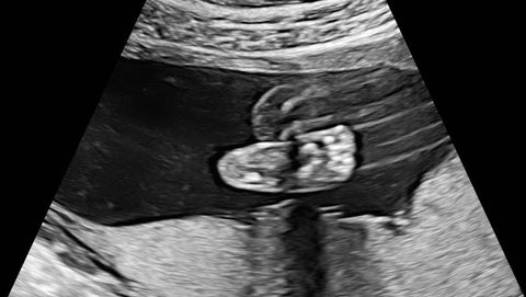 baby z foot on ultrasound image