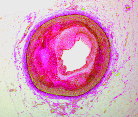 heart disease arteriosclerosis histology slide