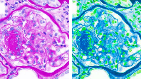 two differently colored diabetes cell images side by side