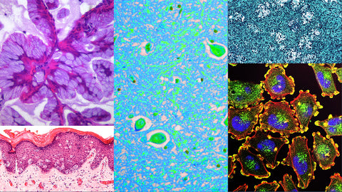 histology slide collage of lung cancer, Alzheimer's, breast cancer, skin cancer and ovarian cancer