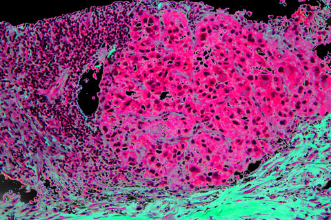 liver cancer histology slide