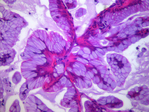 lung cancer cell image histology slide