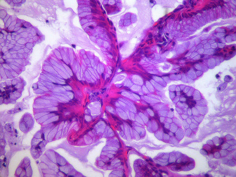 lung cancer histology slide