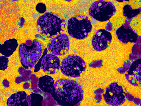 lymphoma cell image