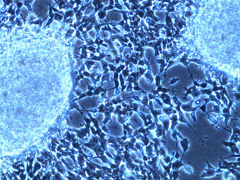 childhood cancer neuroblastoma cell histology slide