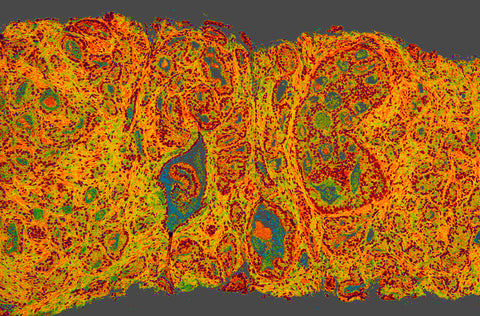 prostate cancer histology slide