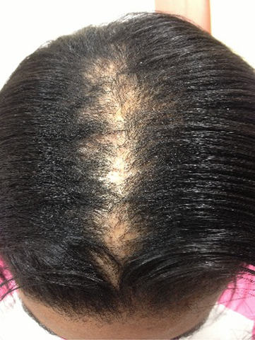 Prevent Black Woman Hair Loss Natural Hair