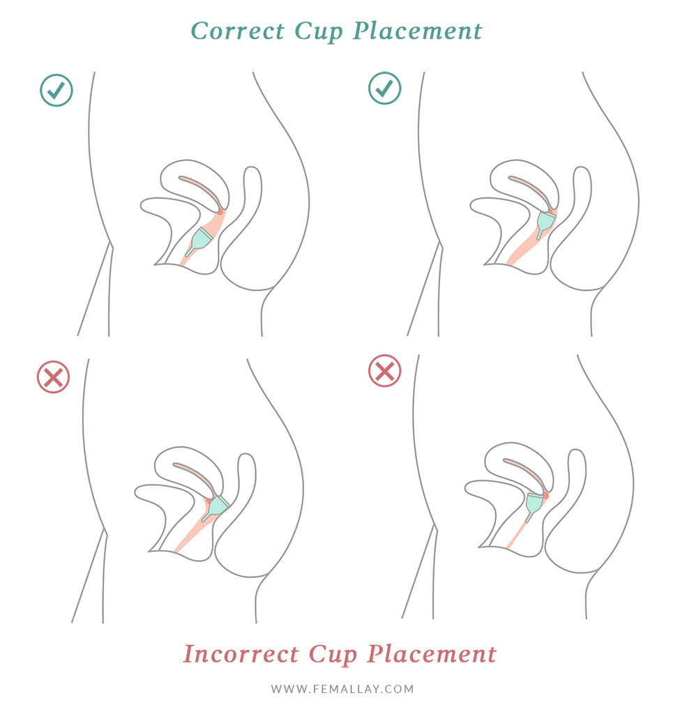 Correct and Incorrect Menstrual Cup Positioning