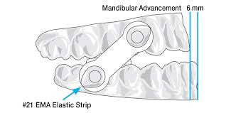 ema device for sleep apnea