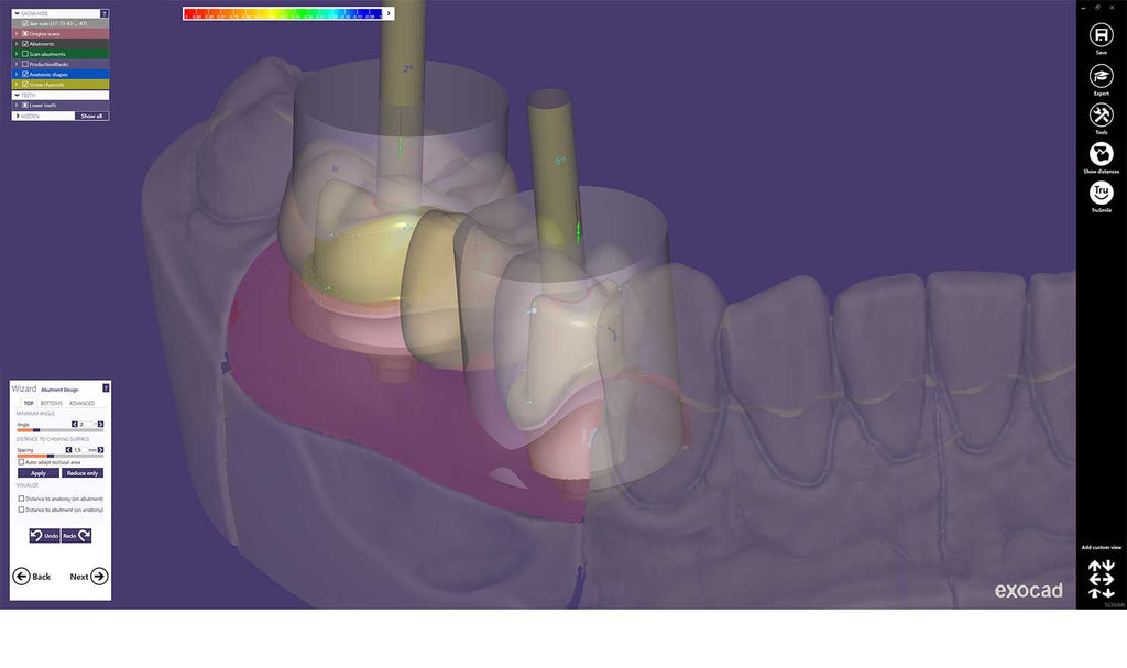 exocad implant library