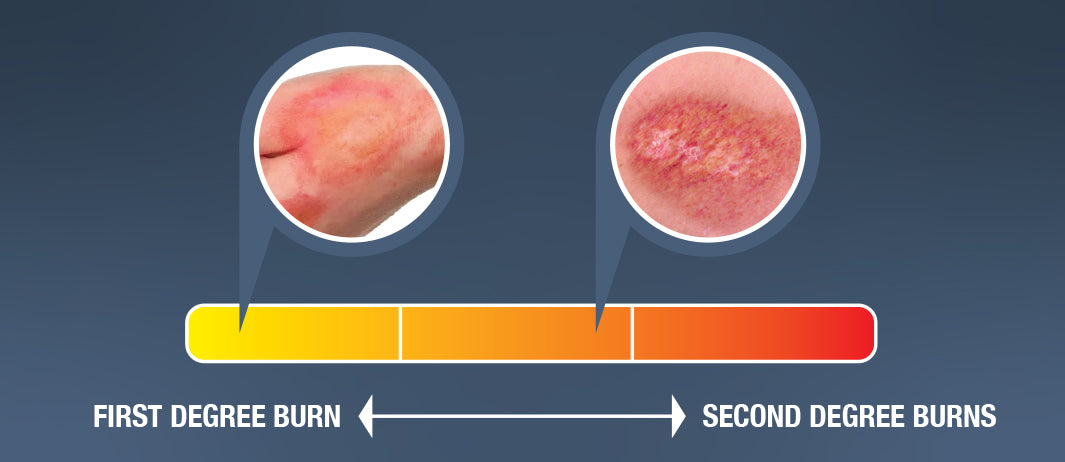 ““radiation_burn””