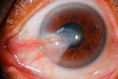 What is Pterygium of the eye? Large pterygium