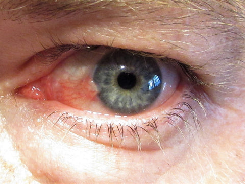 What is pterygium of the eye? Eye disease Australia