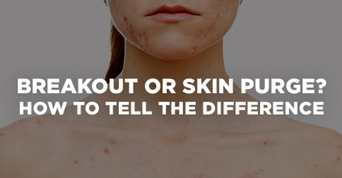 Skin Purging or Breakout
