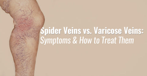 Síntomas y cómo tratar las arañas vasculares y las venas varicosas