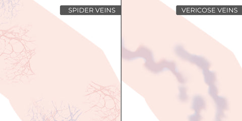 Arañas vasculares versus venas varicosas