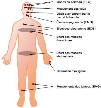 polysomnographie indication