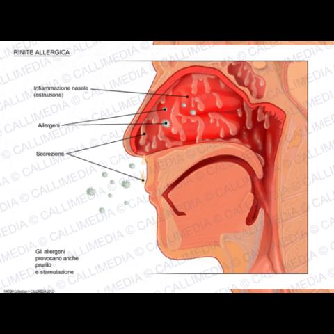 rhinite hypertrophique symptomes