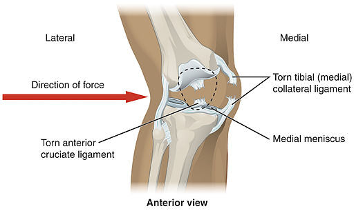 Torn Meniscus Knee Injury