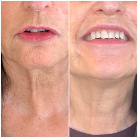 FIBROBLAST PLASMA SKIN TIGHTENING