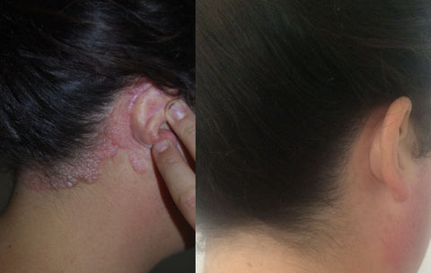 Psoriasis behind ear