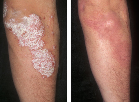 Psoriasis on Leg