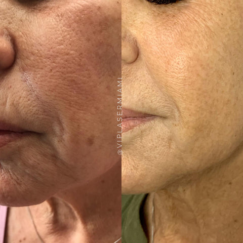 fibroblast plasma skin pen transformations helped tightening imperfections vip such members many just