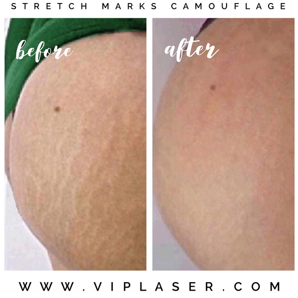 stretch marks camouflage before consultation