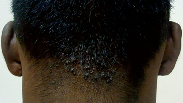 What Is Scalp Acne And How To Get Rid Of It?