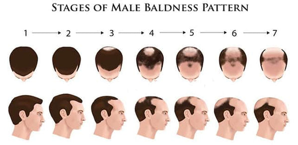 Male Pattern Baldness - blading pattern in hair
